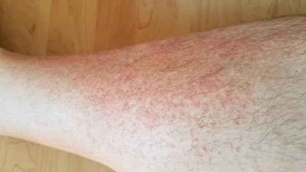 男性腿上的红疹或炎症 — 图库照片