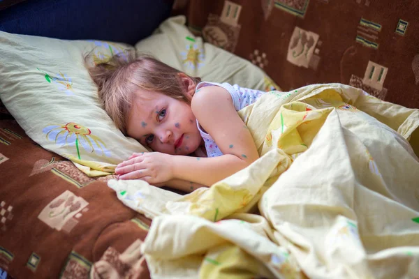 Ребенок с ветрянкой лежит в кровати и отдыхает. — стоковое фото