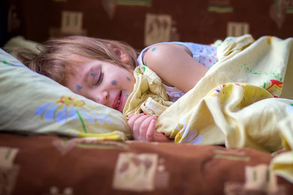El niño que tiene varicela yace en una cama y descansa a ciegas. — Foto de Stock