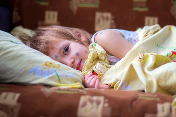 Het kind waterpokken ligt in een bed en heeft een rust — Stockfoto