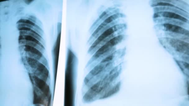 Коронавірус Ковірусна Рентгенівських Променевих Легень Нетипові Діагностичні Зображення Пневмонії — стокове відео