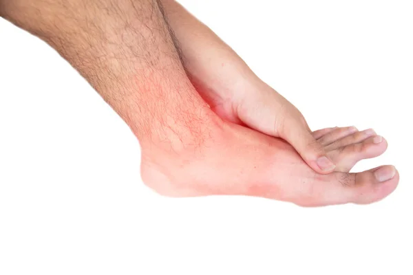 Lesão no pé — Fotografia de Stock