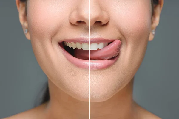 从灰色 牙齿美白概念看白牙贴舌的微笑女性的部分观点 — 图库照片