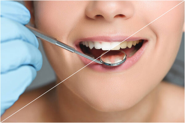 partial view of dentist with dental mirror checking teeth of happy woman, teeth whitening concept