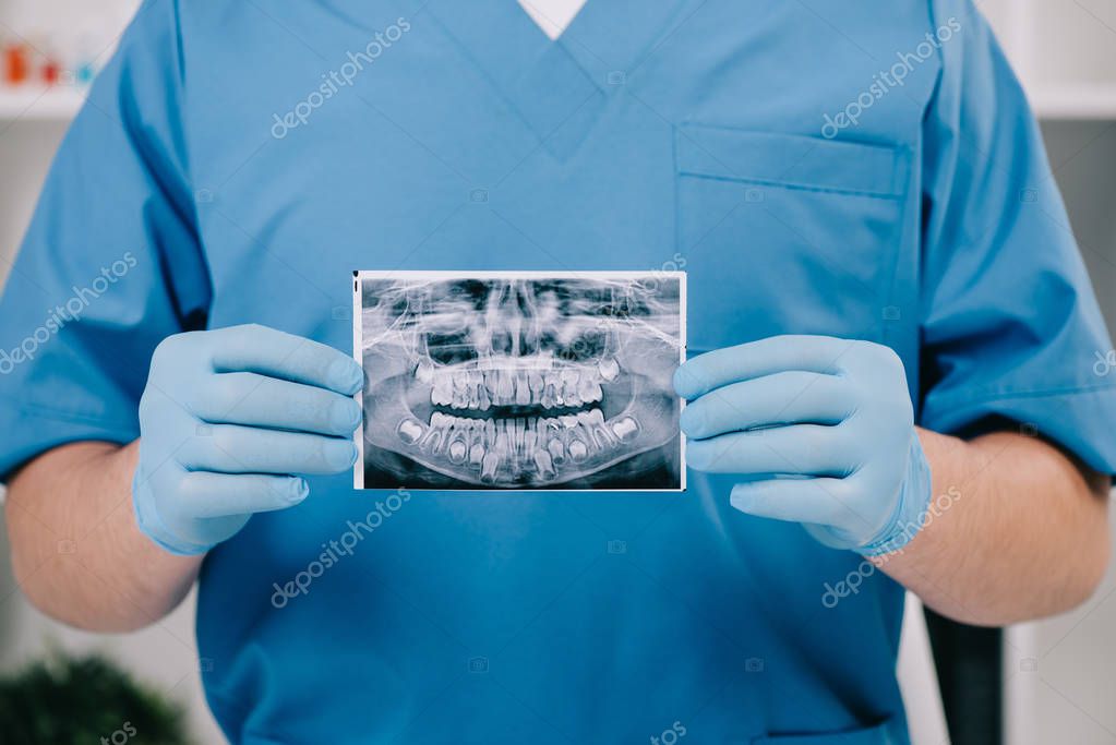 Cropped view of orthodontist holding teeth x-ray in clinic
