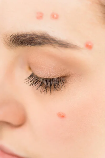 Cropped View Young Woman Acne Face Isolated Grey — Stock Photo, Image