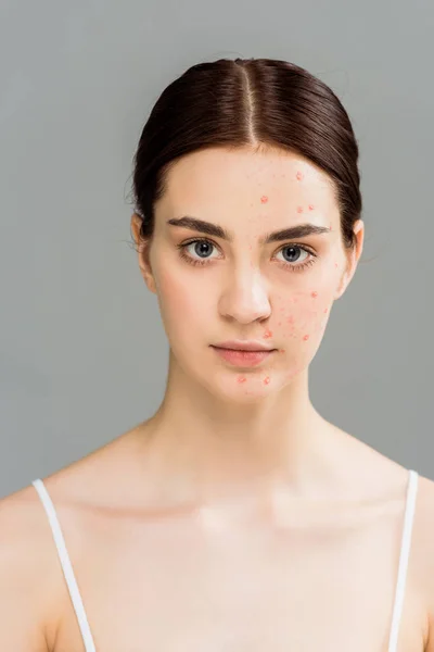 Femme Avec Acné Sur Visage Regardant Caméra Isolée Sur Gris — Photo