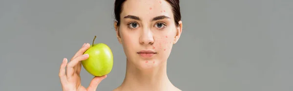 Panoramabild Ung Kvinna Med Akne Ansiktet Som Håller Grönt Äpple — Stockfoto