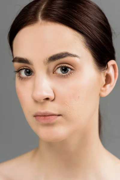 Brunette Young Woman Problem Skin Isolated Grey — Stock Photo, Image