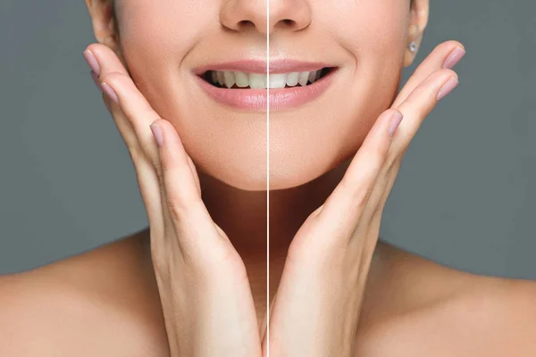 Partial view of smiling woman with white teeth isolated on grey, teeth whitening concept — Stock Photo