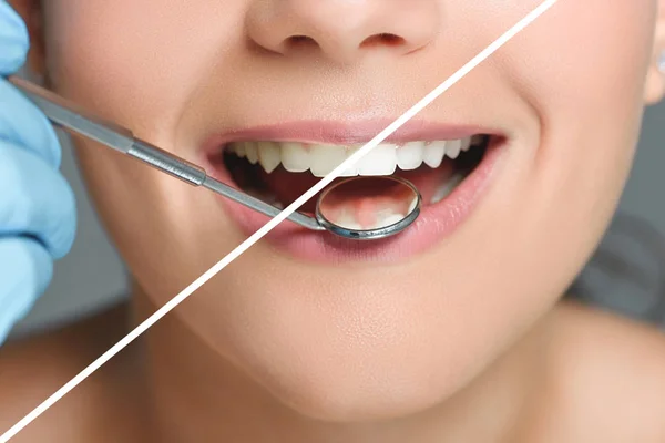 Vista parcial del dentista con espejo dental comprobar los dientes de las mujeres, los dientes concepto de blanqueamiento - foto de stock