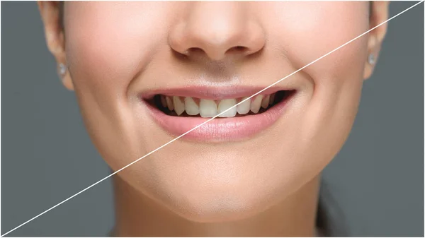 Vue partielle de la femme souriante avec de belles dents blanches isolées sur gris, concept de blanchiment des dents — Photo de stock