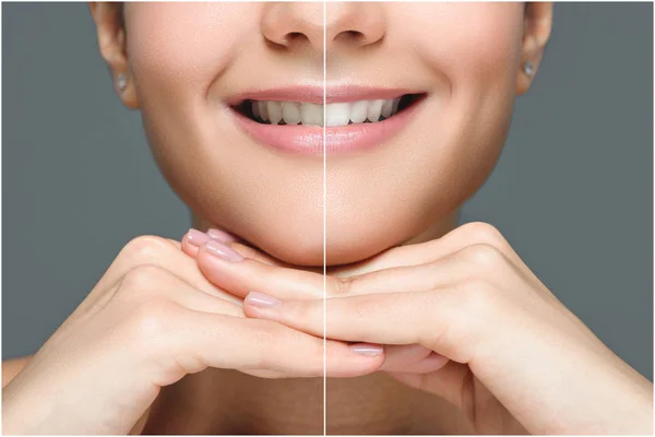 Visão parcial da mulher sorridente antes e depois do clareamento dos dentes isolado em cinza — Fotografia de Stock