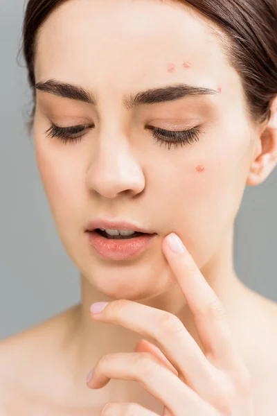 Close up of attractive young brunette woman with acne touching face isolated on grey — Stock Photo