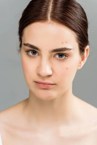 Bouleversé jeune femme brune avec acné sur le visage isolé sur gris — Photo de stock