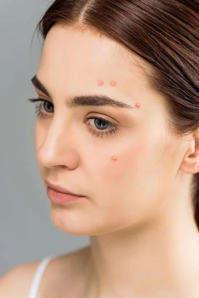 Mujer joven molesta con acné en la cara aislado en gris — Stock Photo