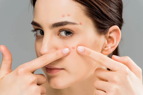 Young woman with acne touching face and looking at camera isolated on grey — Stock Photo