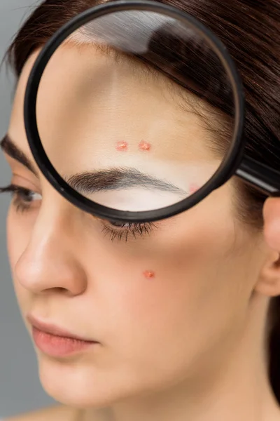 Brunette young woman with magnifying glass near face with acne isolated on grey — Stock Photo