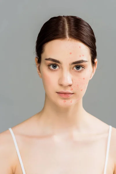 Woman with acne on face looking at camera isolated on grey — Stock Photo