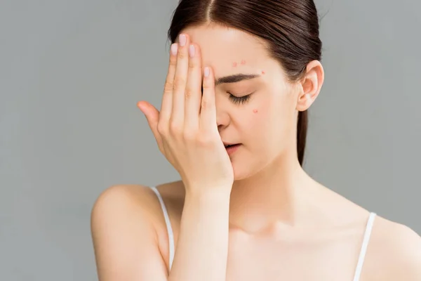 Giovane donna con acne che copre il viso con mano isolata su grigio — Foto stock