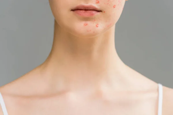 Vue recadrée de jeune femme avec boutons sur le visage isolé sur gris — Photo de stock