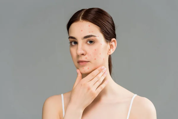 Beautiful young woman with pimples touching face isolated on grey — Stock Photo