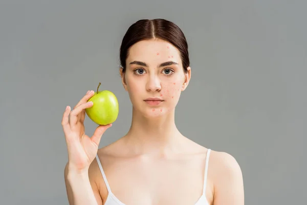 Молода жінка з прищами на обличчі тримає зелене яблуко ізольовано на сірому — стокове фото