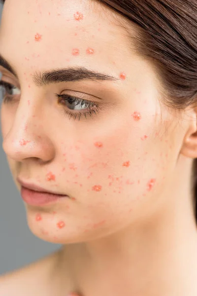 Close up of young brunette woman with pimples on face isolated on grey — Stock Photo