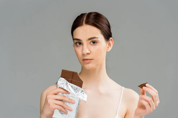 Молода жінка з проблемною шкірою тримає шоколадний батончик і дивиться на камеру ізольовано на сірому — стокове фото