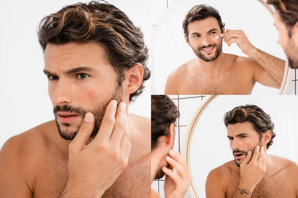 Collage eines Mannes ohne Hemd mit Akne, der im Badezimmer Gesichtscreme aufträgt — Stockfoto