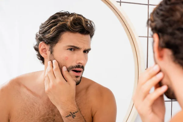 Worried man touching cheek with acne while looking at mirror in bathroom — Stock Photo