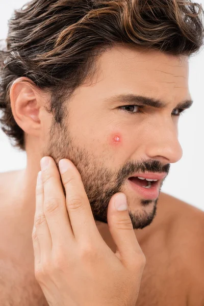 Hombre confundido tocando mejilla con acné aislado en gris - foto de stock