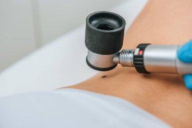 Köstebek çıkarma işlemi sırasında doktorun büyüteç kullandığına dair kırpılmış görüş