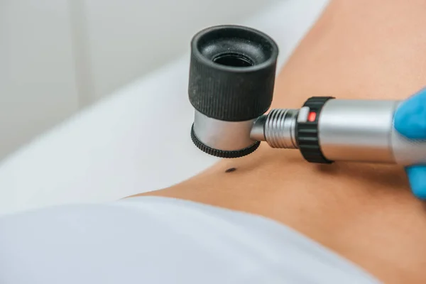 Cropped view of doctor using magnifier during mole removal procedure — Stock Photo