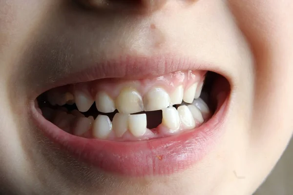 Child missing tooth. Kid missing one tooth. Gap between kids teeth.