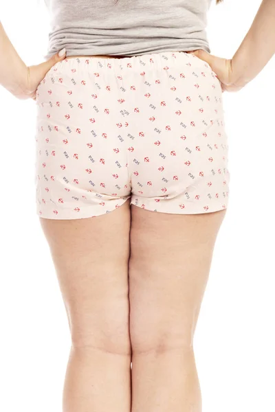 Pernas Uma Mulher Gorda Com Celulite Isolada Sobre Fundo Branco — Fotografia de Stock