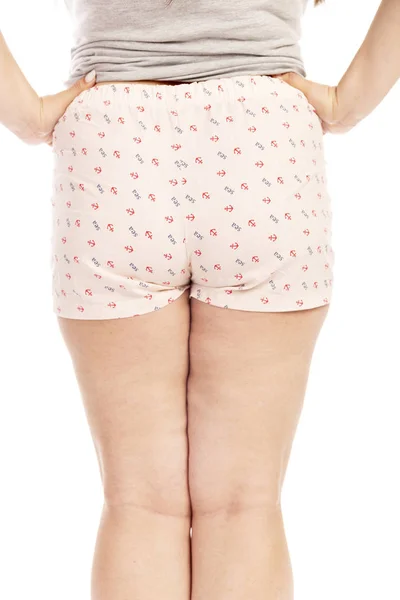 Jambes Une Grosse Femme Avec Cellulite Isolées Sur Fond Blanc — Photo