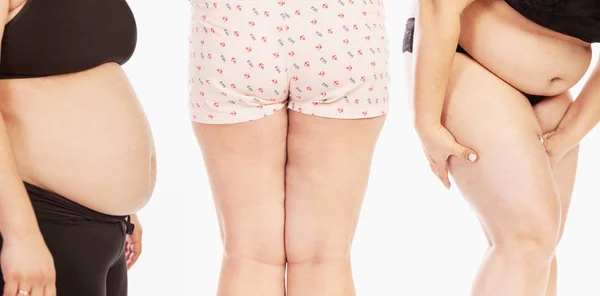 厚实的女性身体 特写腹部 腿与脂肪团 — 图库照片