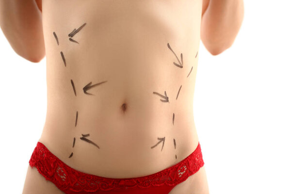 Female body with markup before liposuction