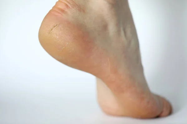 Schmerzhafte rissige Haut am Fuß — Stockfoto
