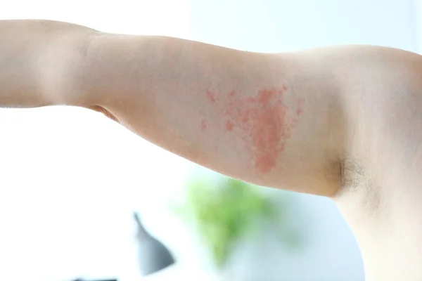 Apuración alérgica dolorosa —  Fotos de Stock