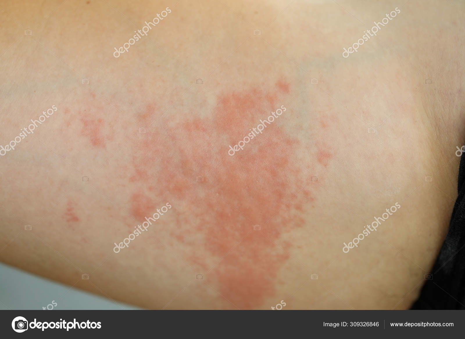 lesion vascular piel lesion vascular piel