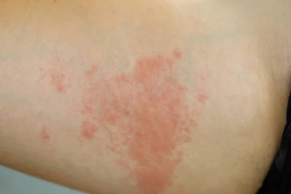 Allergische Rush op de huid — Stockfoto