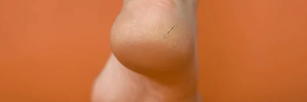 Close-up lower part male foot, heel with crack. — 스톡 사진