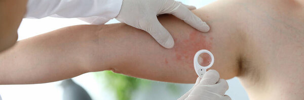 Male dermatologist examines rash on leg patient