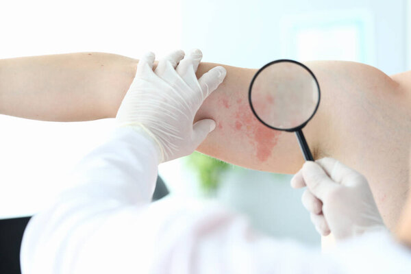 Gloved doctor looking at rash with magnifier