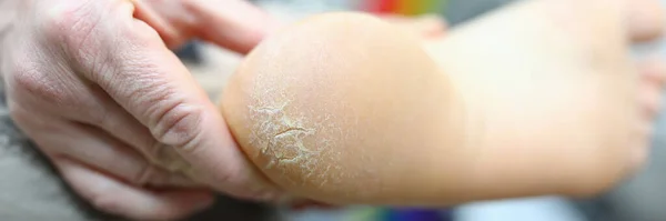 皮膚科の問題と乾燥 — ストック写真