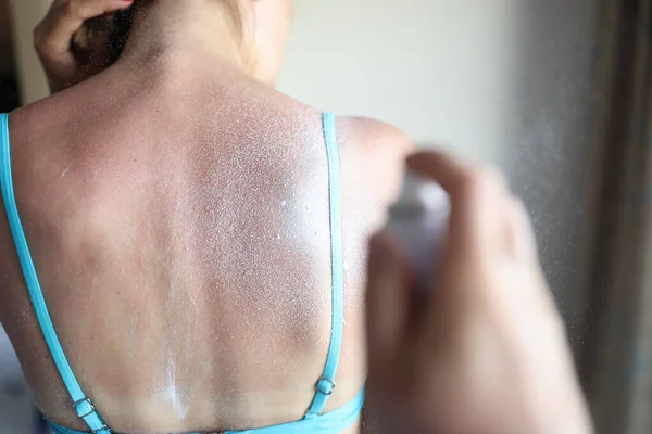 Aerosol protettivo viene applicato alle scottature solari sulla schiena delle donne — Foto Stock