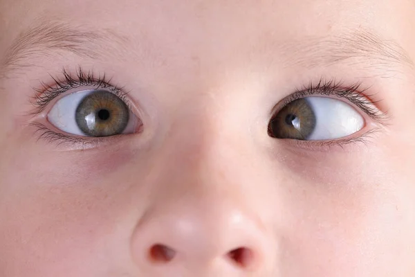 Childs wajah dengan juling dan bintik-bintik di hidung. — Stok Foto