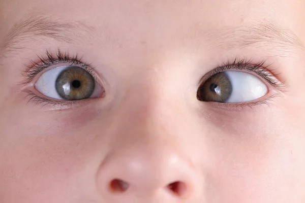 Childs face with squint and freckles on nose. — Stock Photo, Image